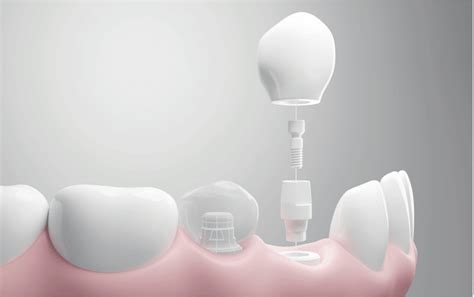  Zendurieder: Revolutionair Materiaal voor Duurzame Implantaten en Biologische Vervangers!